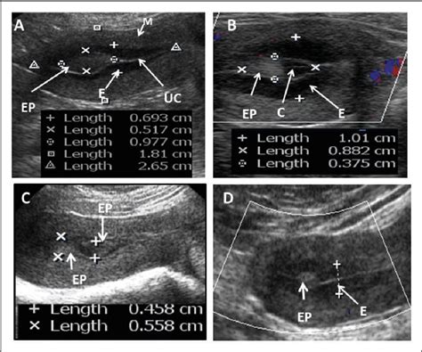 Menorrhagia Ultrasound