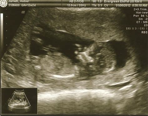 Raising Elora: Twelve Week Ultrasound