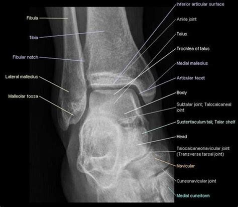 Leg Ankle Foot Imaging Flashcards Quizlet