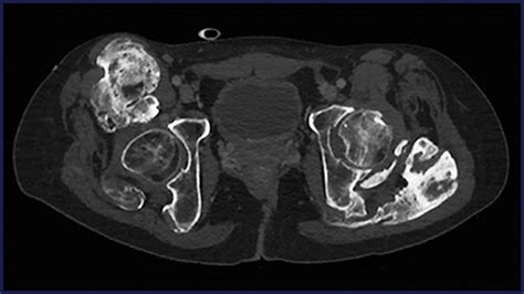 Preoperative Arterial Embolization For Heterotopic Ossification Of The Hip Journal Of Vascular