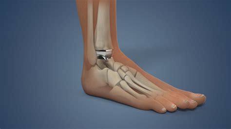 ® Total Ankle Replacement Animation Teaser Trailer