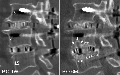 Comparison Of Short Term Radiographical And Clinical Outcomes After