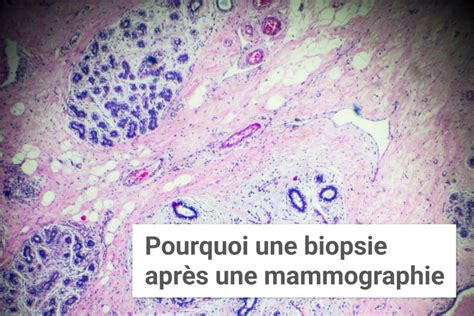 Pourquoi Une Biopsie Apr S Une Mammographie Institut Du Sein Paris