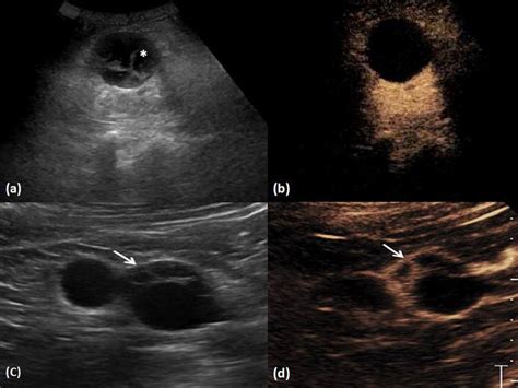 Current Imaging Techniques In Renal Cell Carcinoma Intechopen