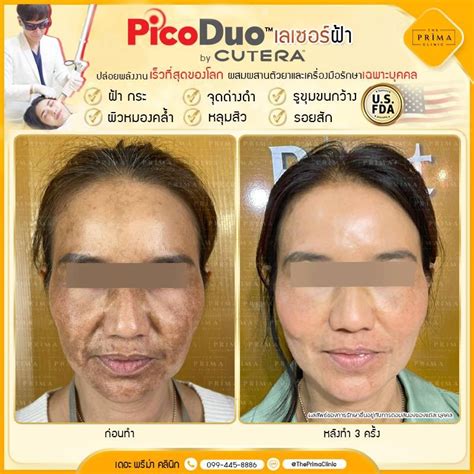 รีวิว The Prima Clinic Si Racha เดอะ พรีม่า คลินิก ศรีราชา ศรีราชา เลเซอร์ฝ้า เปลี่ยนผิวใหม่