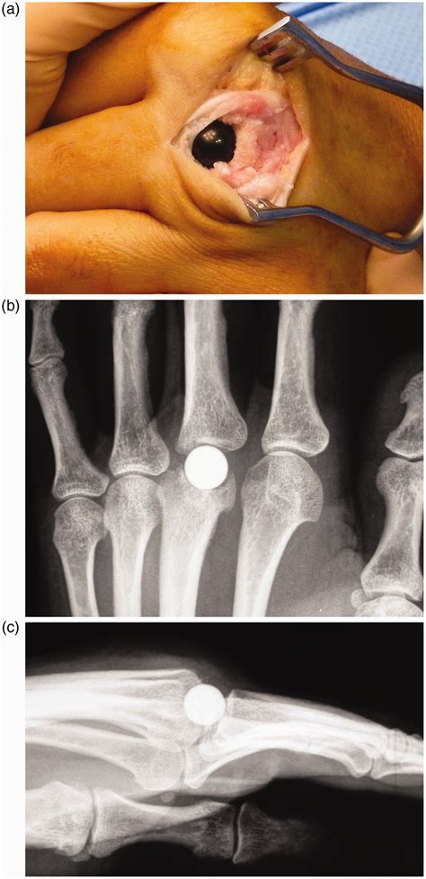 Medium And Long Term Outcomes For Hand And Wrist Pyrocarbon Implants