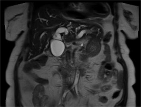 Obstructive Jaundice Secondary To Peribiliary Cyst Within The Common