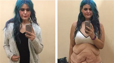 Woman Shows Off Excess Skin After 190 Pound Weight Loss Life And Style