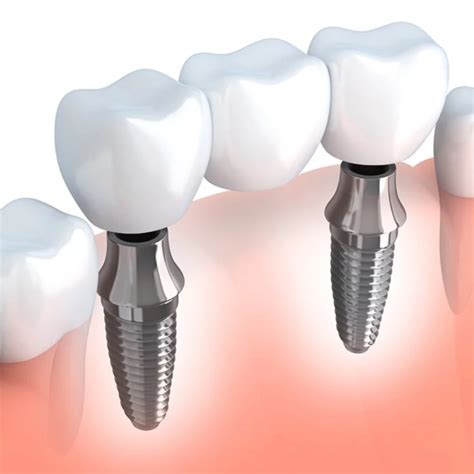 Dental Implants Platinum Dental Surgery