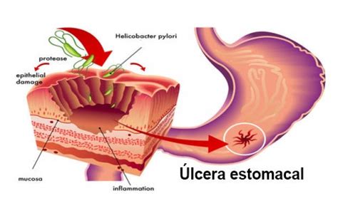 Tratamientos Naturales Para Combatir La Bacteria Helicobacter Pylori