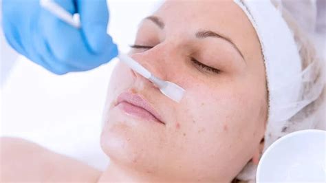 Chemical Peel For Acne Scars Procedure And Benefits Dmc Dubai