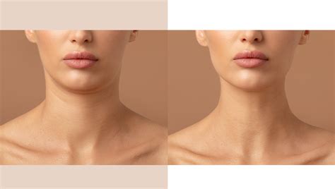 Ablative Vs Non Ablative Laser Skin Resurfacing Which Is Right For You