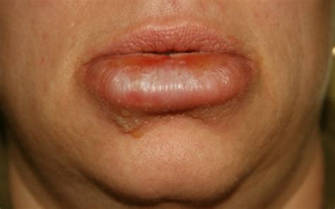 cyst on upper lip - pictures, photos