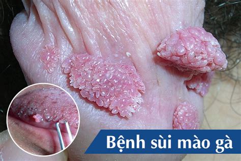 sui mao ga  nam dau hieu nguyen nhan va cach dieu tri
