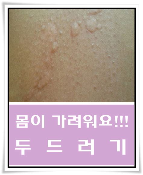 피부가 가렵고 부풀어요 두드러기와 코로나후유증 코로나후유증피부질환 혈관부종 피부묘기증 한랭두드러기 콜린성두드러기