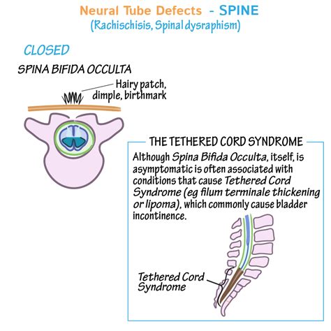 Embryology Glossary Neural Tube Defects Ditki Medical Biological