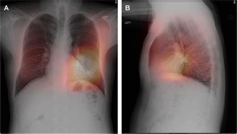 Posterior Anterior A And Lateral Chest X Ray B Demonstrating Why