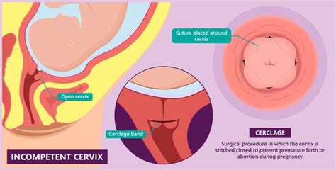 Cervix Cerclage Royalty Free Photos And Stock Images Shutterstock