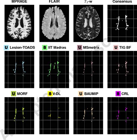 Figure 3 From Longitudinal Multiple Sclerosis Lesion Segmentation Resource And Challenge