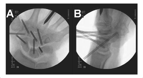 Conventional X Ray After Placing The Probes Into Each Carpal Bone And