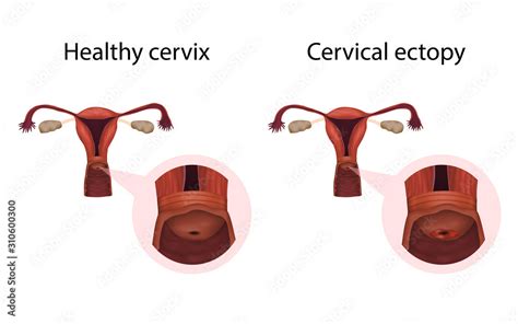 Cervix Ectopy And Healthy Organ Erosion Cervical Disease Medical