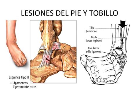 Lesiones Deportivas M S Comunes En Los Miembros Inferiores Centro