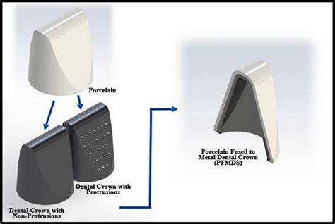 The Schematic Representation Of The Porcelain Fused To Metal Dental Crown Download Scientific