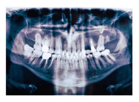 Radiografías dentales Qué son y qué tipos existen Iglesias Piñón