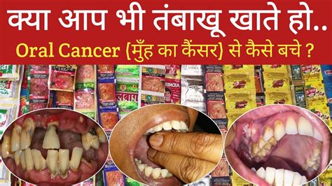 Oral Cancer L मुँह का कैंसर कैसे होता है L मुँह का कैंसर से कैसे बचे L