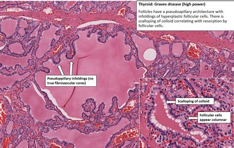 Thyroid Graves Disease Nus Pathweb Nus Pathweb