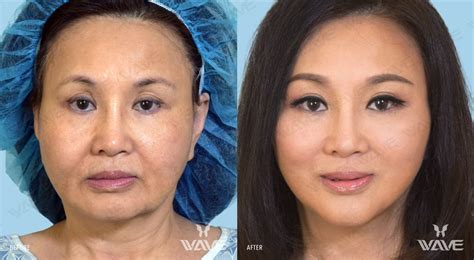 Wavelift Los Angeles Wave Plastic Surgery Plastic Surgery Facelift