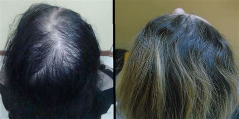 PRP Hair Loss Therapy In Dubai Hair Transplant Dubai