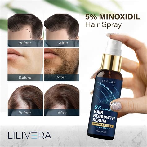 5 Minoxidil Spray De Crecimiento Del Cabello Suero Para El