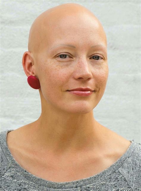 Jennifer Bald Women Alopecia Lost Hair