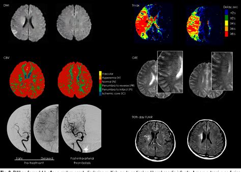 Pdf Multimodal Mri For Ischemic Stroke From Acute Therapy To