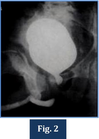 Figure From Management Of Pelvic Fracture Urethral Distraction Defect