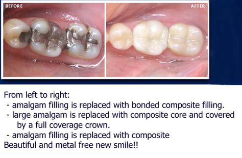 Dental Crowns And Bridge Work Langley Bc Dr Steve Tschach