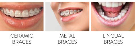 Lingual Braces Cost