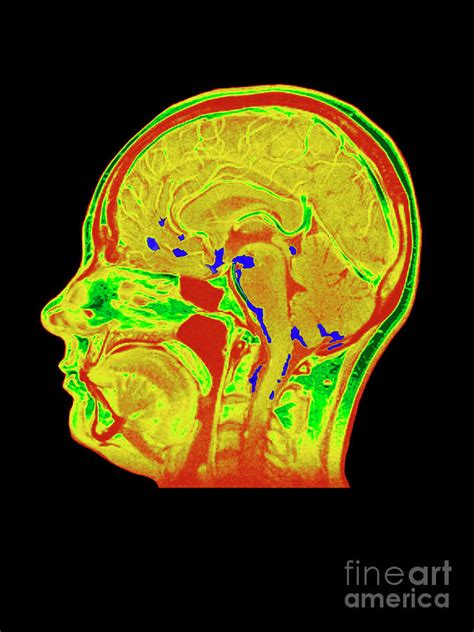 Coloured Mri Scan Of Human Brain With Meningitis Photograph By Simon Fraserroyal Victoria