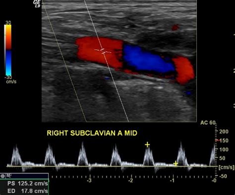 Subclavian Artery Ultrasound