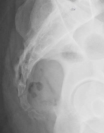 Med Imaging MSK XRAY Lateral Pelvis Diagram Quizlet