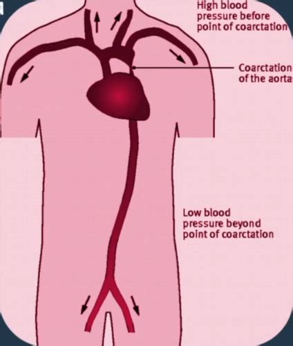 Pediatric Cardiology Flashcards Quizlet