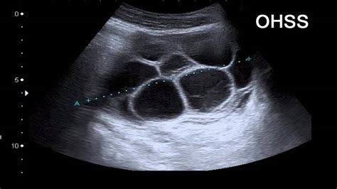 Cyprus IVF Treatment Centre Ovarian Hyperstimulation Syndrome OHSS