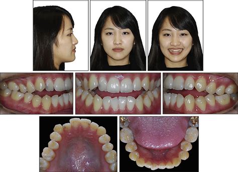 Nonsurgical Correction Of A Class Iii Skeletal Anterior Open Bite Malocclusion Using Multiple