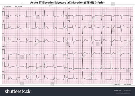 Inferior Myocardial Infarction Ecg