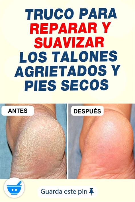 El Truco Para Reparar Y Suavizar Los Talones Agrietados Y Pies Secos En