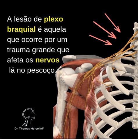 Causas de lesão do Plexo Braquial você sabe quais são