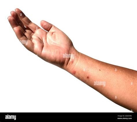 Rashes And Red Blisters On The Skin Of Human Arm And Hand Islated On White Background