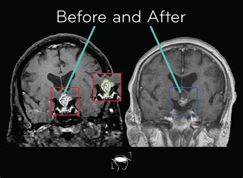 Brain Tumor Types Glioblastoma Meningioma More