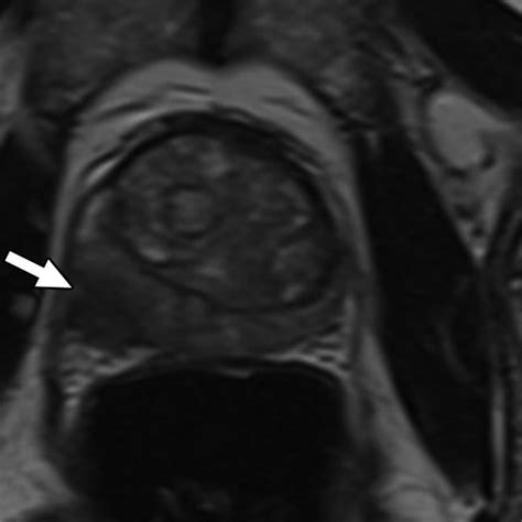 Prostate Cancer Comparison Of 3d T2 Weighted With Conventional 2d T2